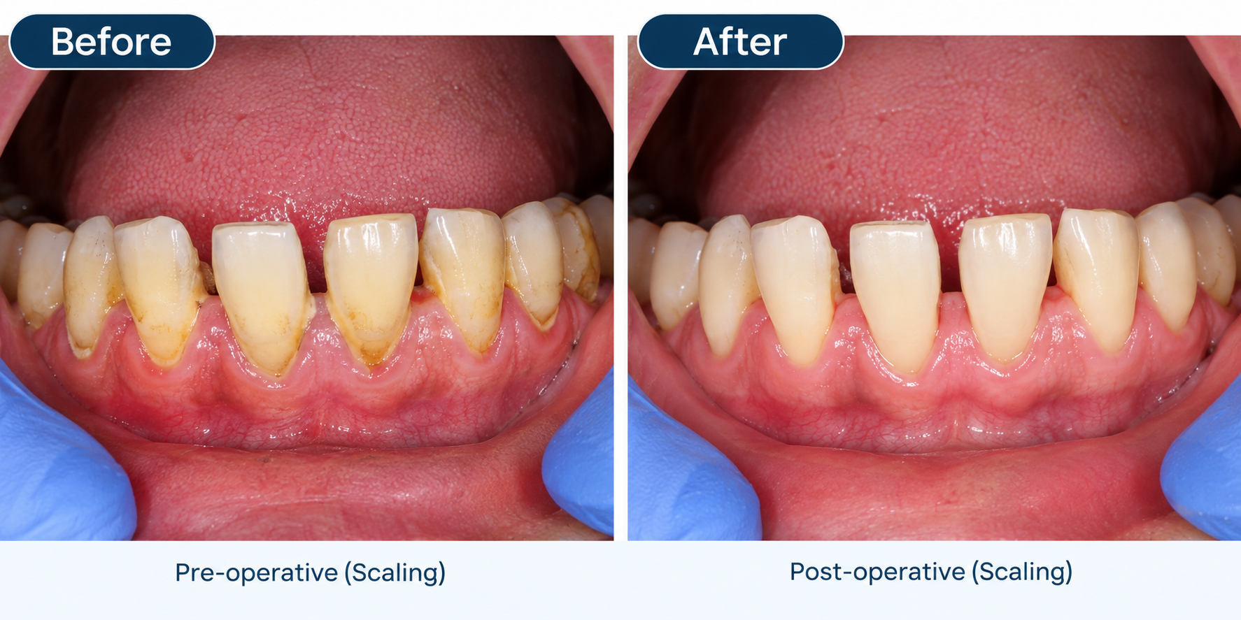 Gum Health